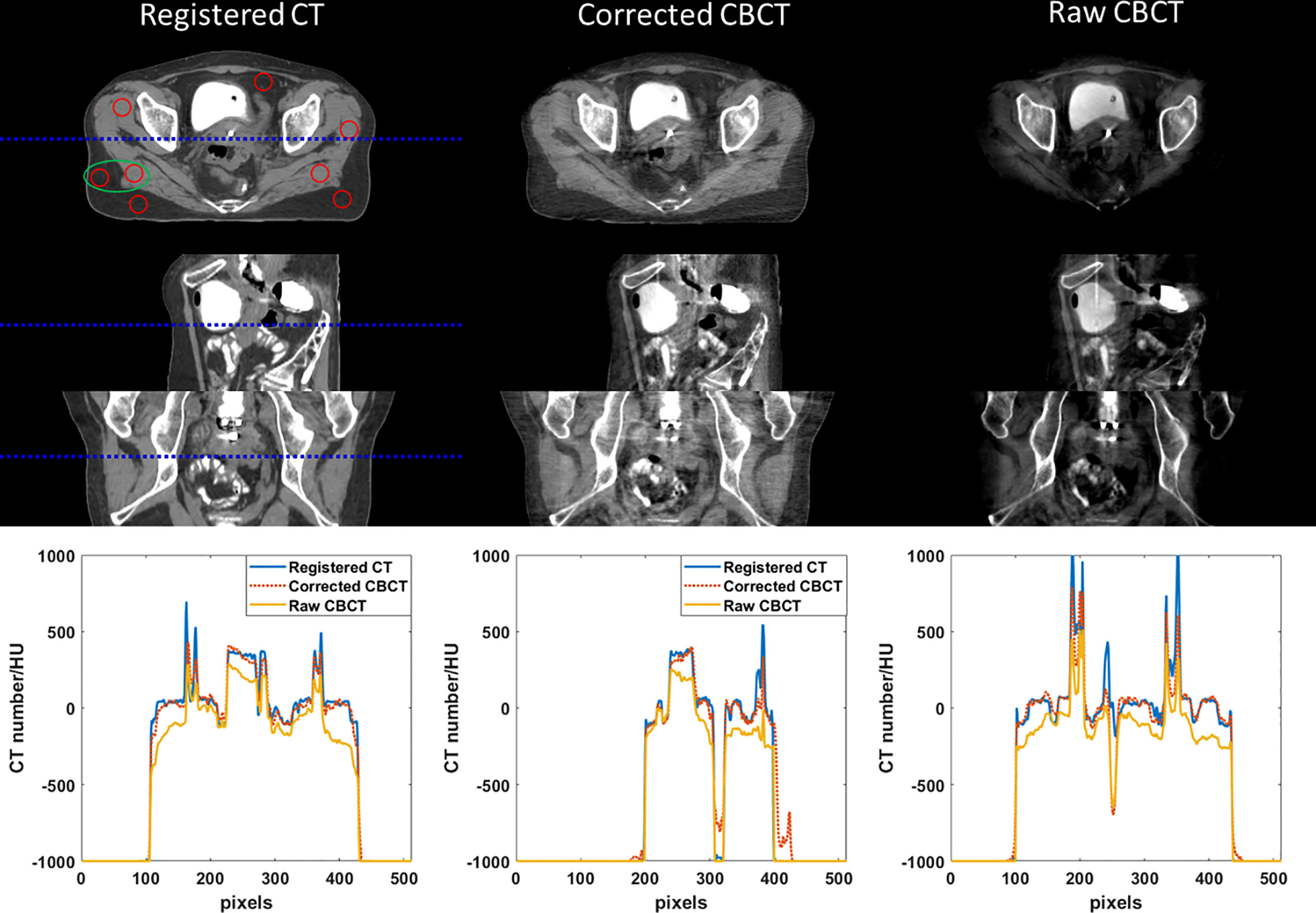 Development and validation of a scatter-corrected CBCT image-guided method for cervical cancer brachytherapy