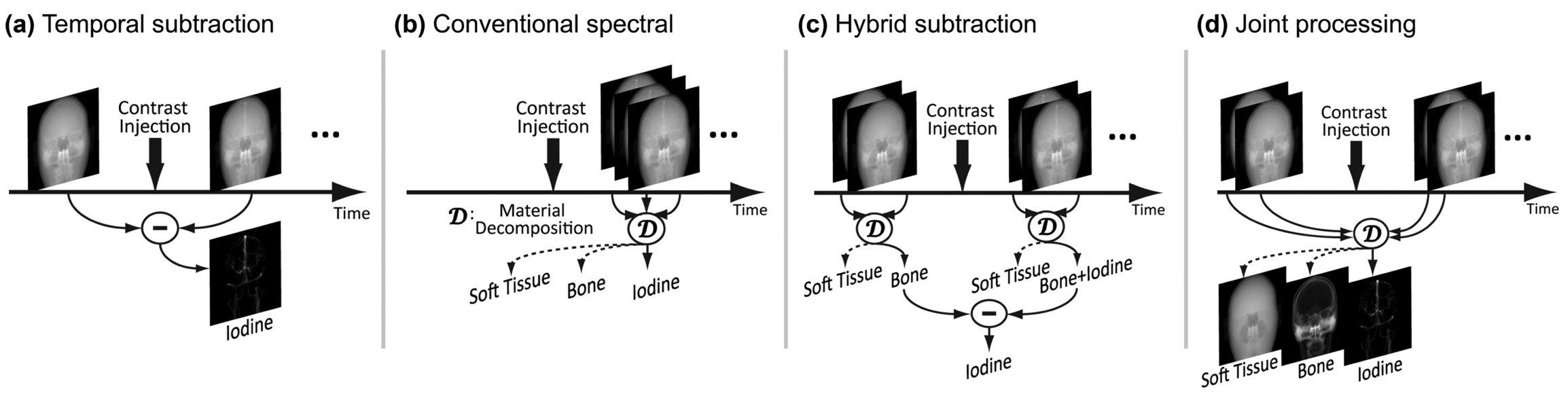 Joint Temporal and Spectral Processing for Improved Digital Subtraction Angiography Using Photon-Counting Detectors