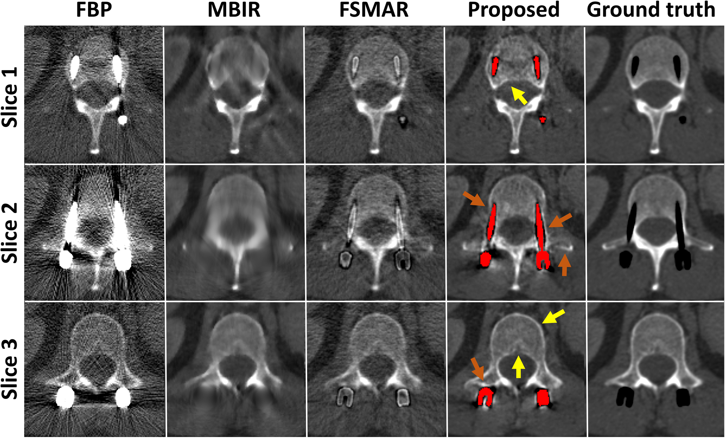 Joint CT reconstruction of anatomy and implants using a mixed prior model